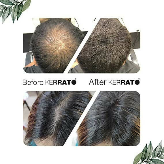 Kerrato Hair Fibres For Thinning Hair (Natural Black) - 4 gm