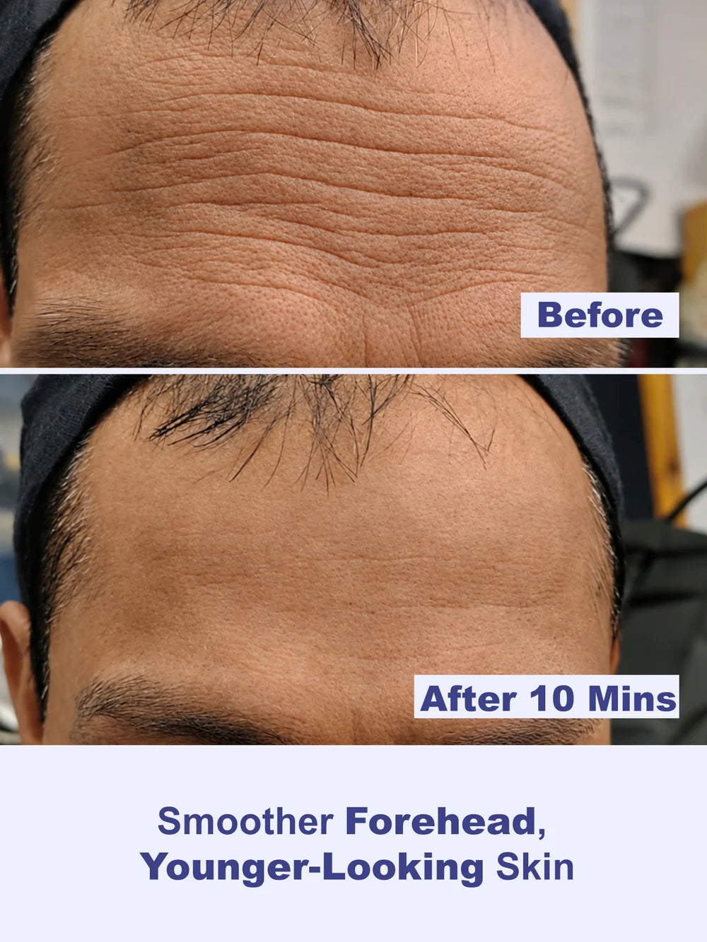 Instant Wrinkle Eraser Face Tightener