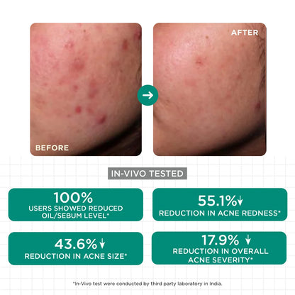 Acne Control Mask