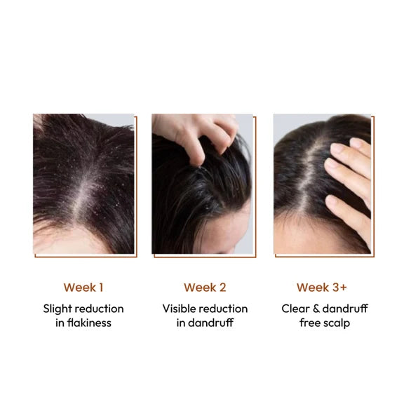 SANCTUS 4% Dandelix Pro Anti-Dandruff Hair Serum For Scalp - 50 ml