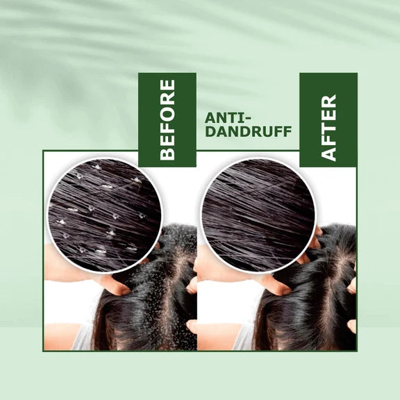 Nuerma Science Anti-Dandruff Hair Oil | Dandruff Relief & Scalp Rejuvenation - 200 ml