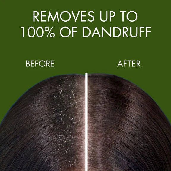 Samisha Anti Dandruff Spray - 100 ml