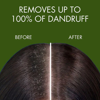 Samisha Anti Dandruff Spray - 100 ml