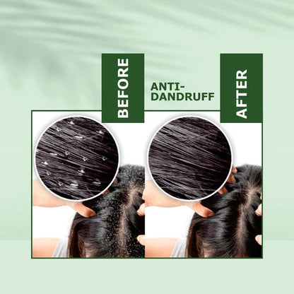 Nuerma Science Anti-Dandruff Oil | Rejuvenate Your Scalp, Rediscover Confidence - 100 ml