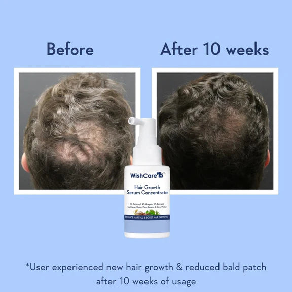 Wishcare Hair Growth Serum Concentrate With 3% Redensyl, 4% Anagain, Rice Water, Biotin - 30 ml - Pack of 1
