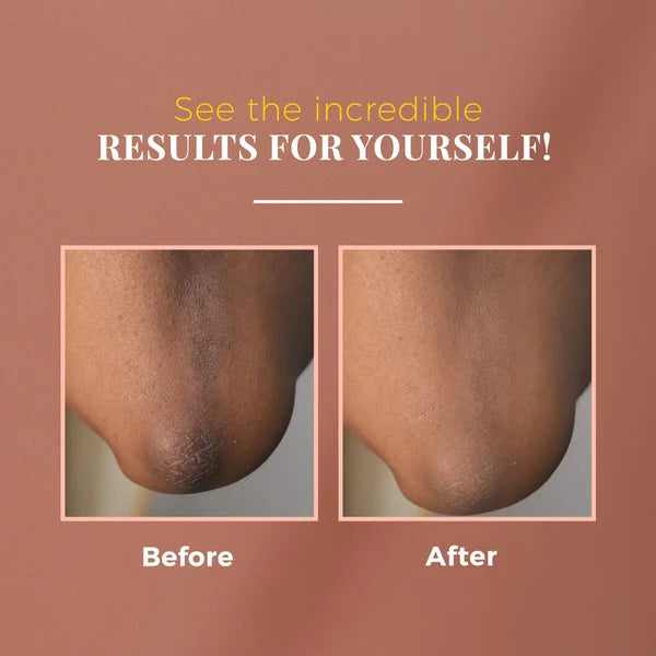 Anti-Pigmentation Kit - Nutmeg & Arjuna Bark for Uneven Skin Tone
