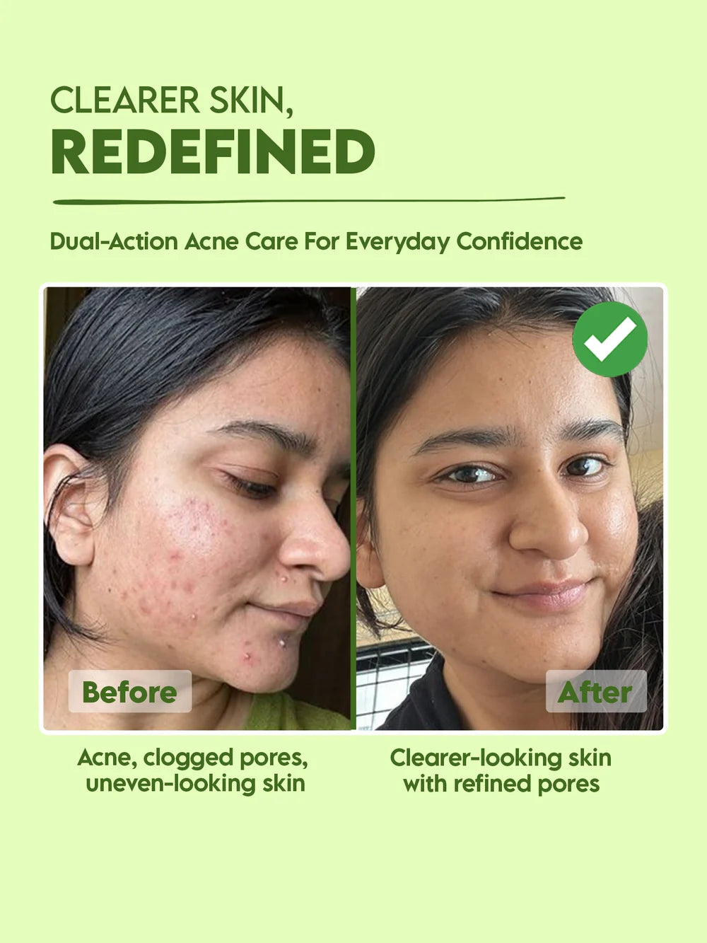 Anti-Acne Zero Acne Serum