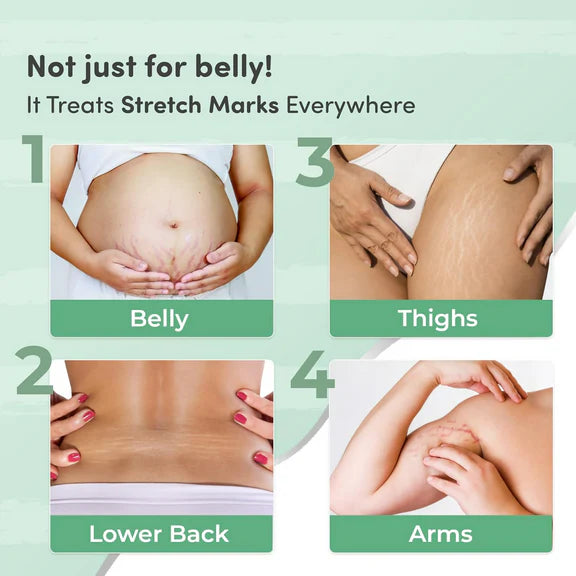 Mylo Care Stretch Marks Combo - Combo