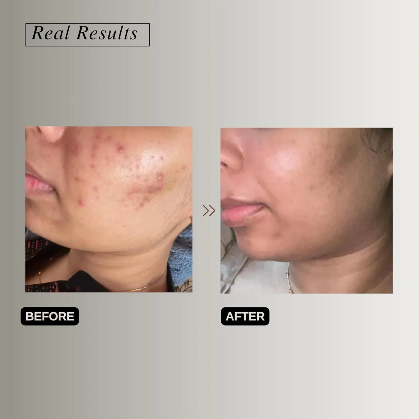 The Formularx Hydra Veil Malazia Hyaluronic Acid Gel Moisturizer - 50 gm