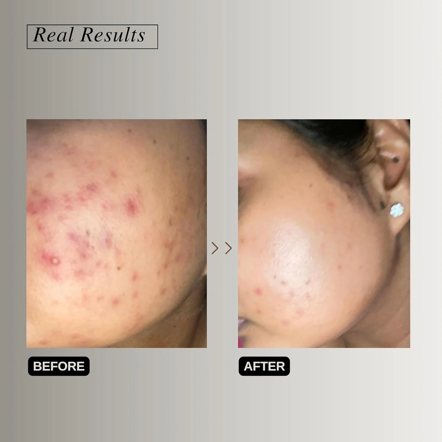 The Formularx Barrier Relief Ceramide Lightweight Moisturizer With Niacinamide & Hyaluronic Acid - 50 gm