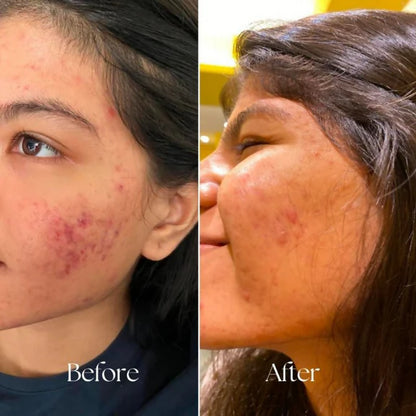 BiE Calm Your Zits Anti Acne Gel - 20 gm