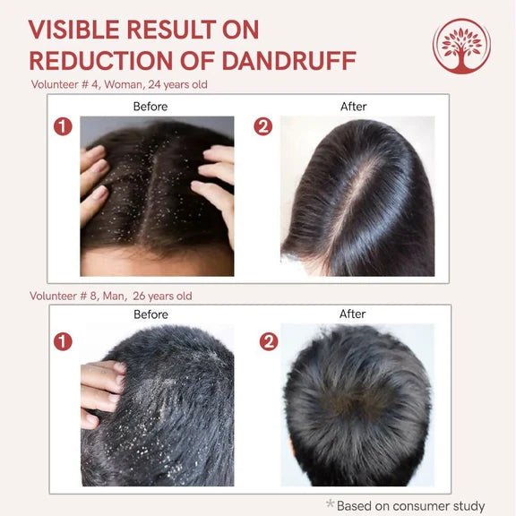 Ivory Natural Dandruff Hair Serum For Nourishing Dry Scalp - 55 ml