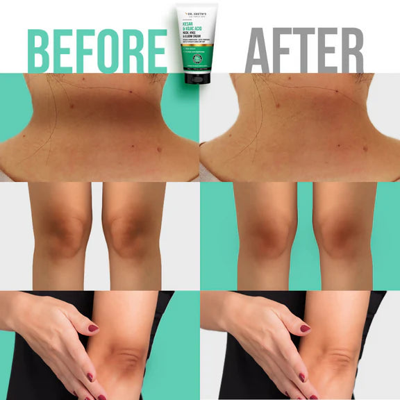 Dr. Sheth's Kesar & Kojic Acid Neck Knee & Elbow Cream - 50 gm