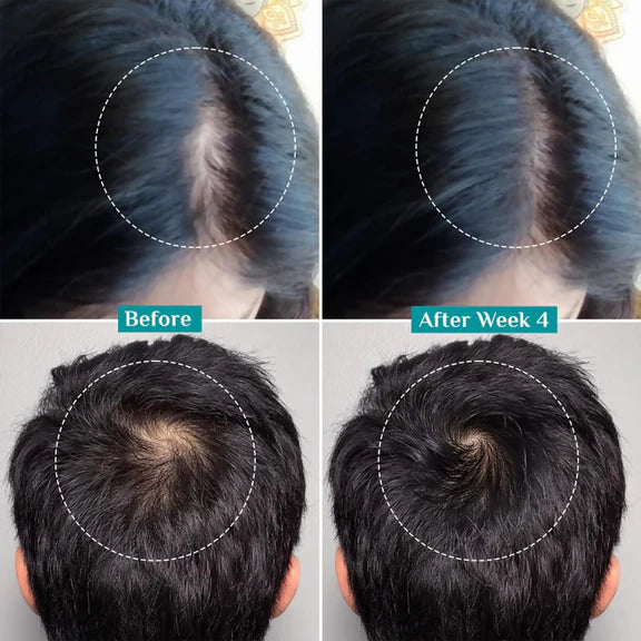 Pilgrim 3% Redensyl, 4% Anagain & 5% Capilia Stem Cell Complex Advanced Hair Growth Serum Roll-On - 25 ml