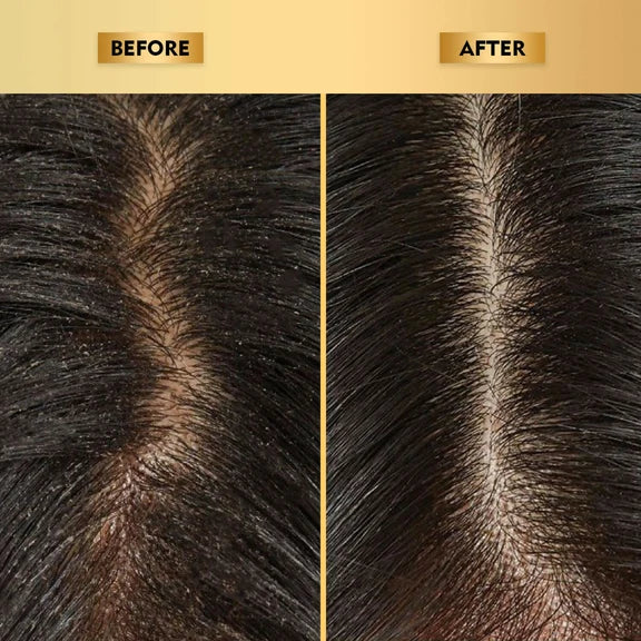 The Skin Story Anti-Dandruff Hair Scalp Serum - 40 ml