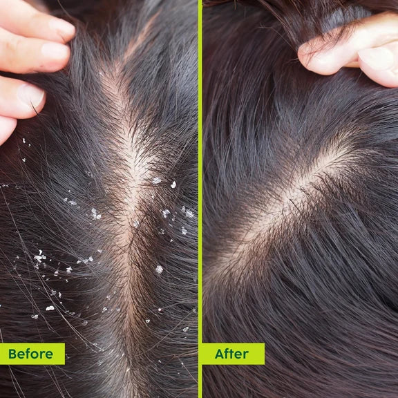 PLIX The Plant Fix Neem Anti-Dandruff Advanced Hair Serum For Reduce Dandruff & Inflammation - 50 ml