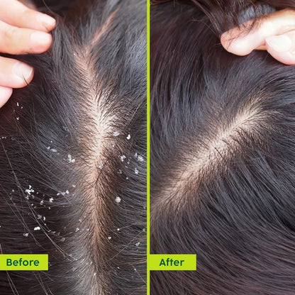 PLIX The Plant Fix Neem Anti-Dandruff Advanced Hair Serum For Reduce Dandruff & Inflammation - 50 ml
