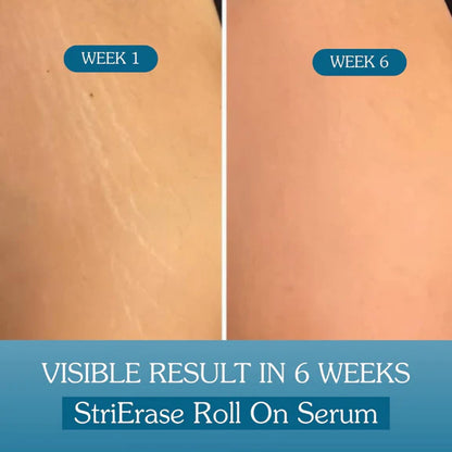 Bake StriErase™ Stretch Marks Removal Roll-On Serum - 50 ml