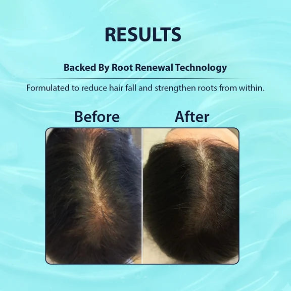 Dermistry Follicusan Hairgenyl & Caffeine Anti Hair Fall Control Serum - 50 ml